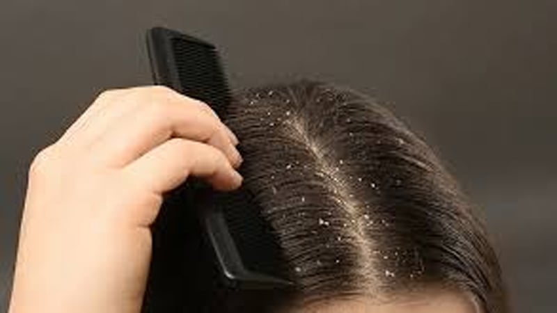 Read more about the article শীতে বেড়েছে খুশকির সমস্যা? সমাধানে যা করবেন